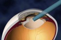 3D lens implant