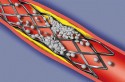 Artery with blood clot