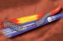 Stent