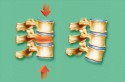 Vertabrae fracture
